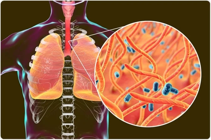 What is whooping cough?